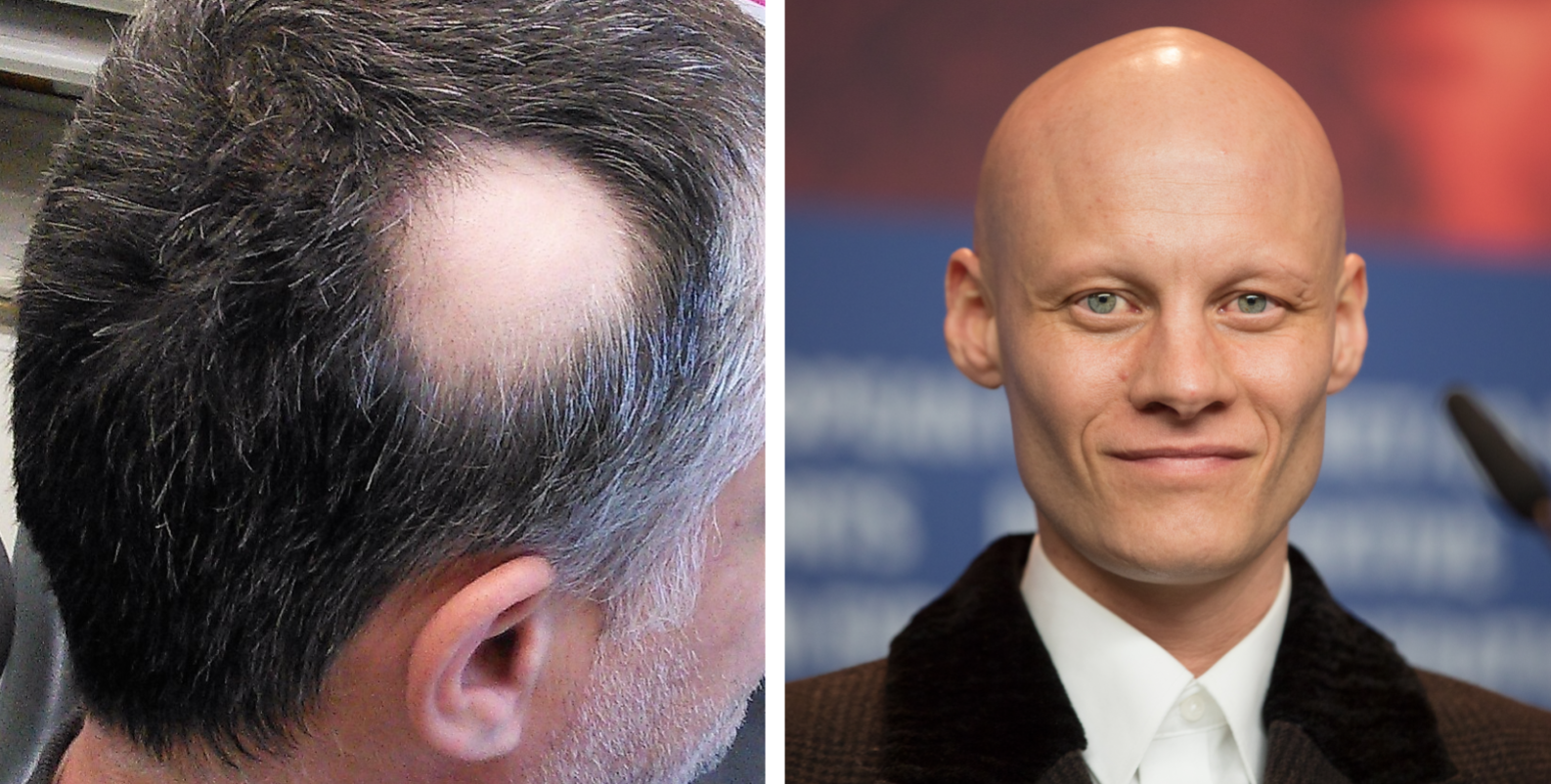 Alopecia kan innebära att håret faller av delvis eller helt.
